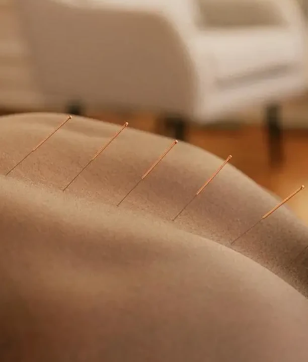 Akupunkturnadeln im Rücken entspannt